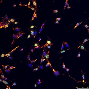 CldU and IdU labeling to detect replication fork stalling in recurrent tumor cells. 