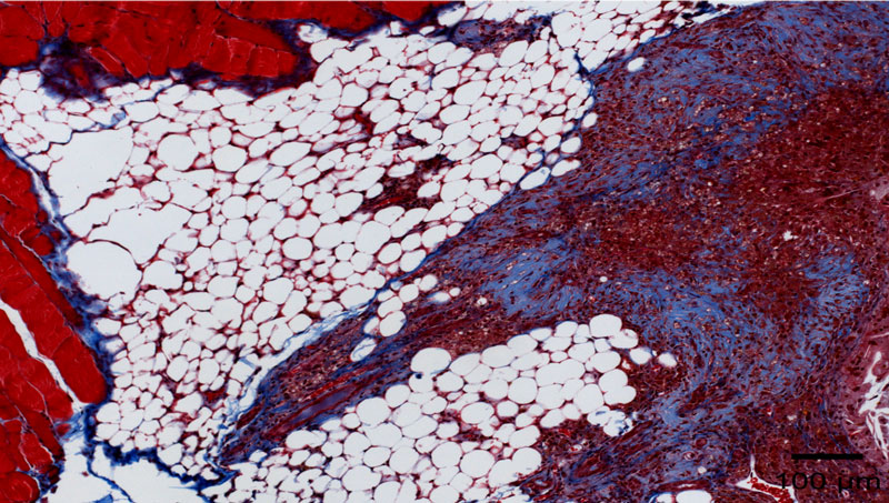 Masson’s Trichrome staining showing abundant collagen deposition in a residual tumor in the mammary gland.