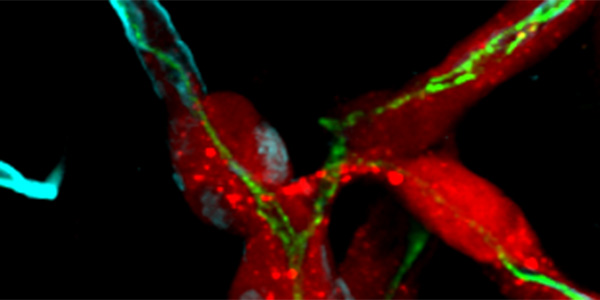 Breast cancer brain metastasis