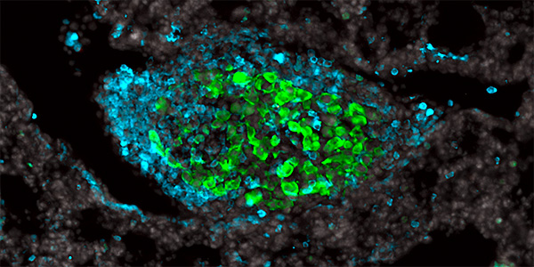 Breast cancer lesion in lung