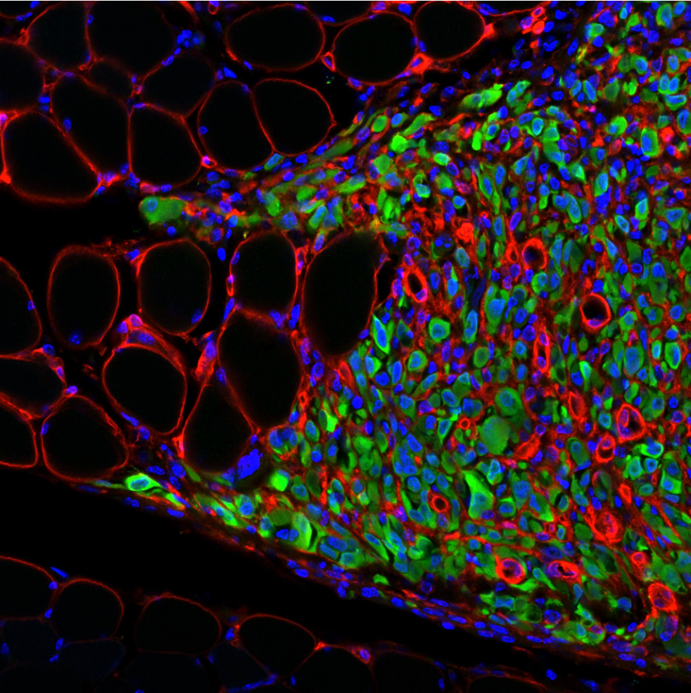 Breast tumor cells colonizing skeletal muscle