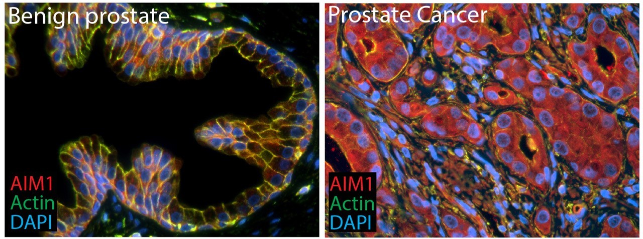 Benign Prostate and Prostate Cancer