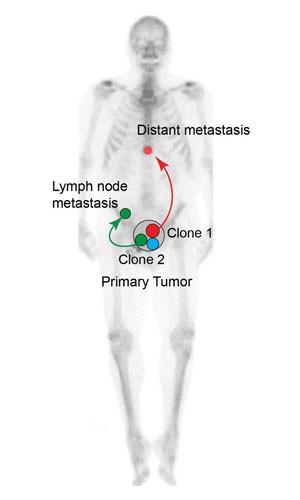 Distant Metastasis