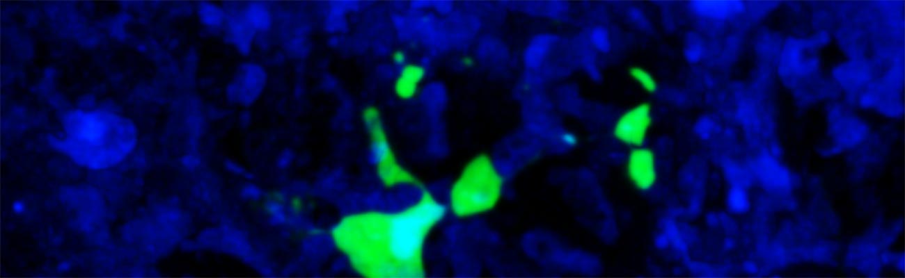 Melanoma Metastasis (green) dies in mouse lung