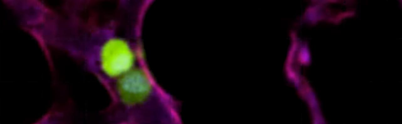 Paired melanoma metastases (green) enter the lung vasculature (purple)