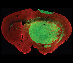 Glioblastoma cells