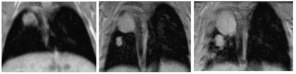 Tumor progression in mouse model