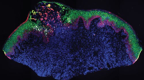 hsv lesion